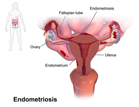 Endometriosis Causas síntomas y tratamiento