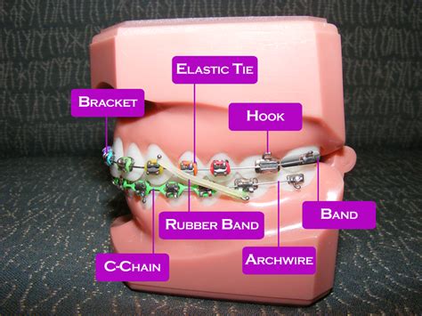 Braces Diagram « Top Concord Orthodontics