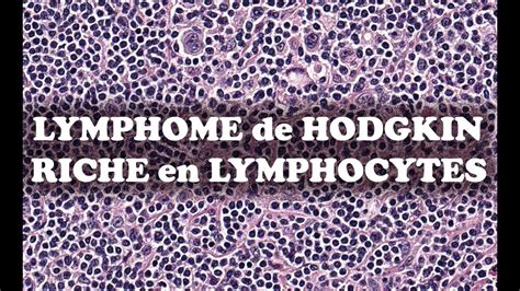 Le Lymphome De Hodgkin Classique Riche En Lymphocytes Pathologie