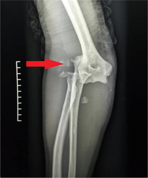 Standard X Ray Of The Elbow Showing A Terrible Triad With Type