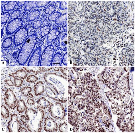 Immunostaining Of Forkhead Box Protein A1 Foxa1 In Colorectal Cancer