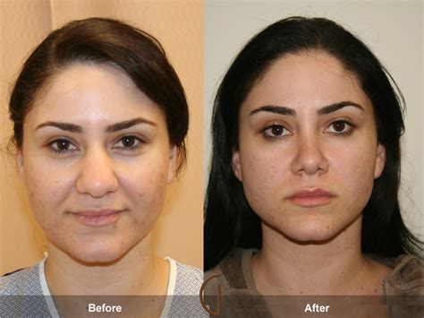 Before & After Rhinoplasty 3 | Nose Job Surgeon Orange County