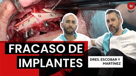 CIRUGÍA Fracaso de Implantes y Recolocación de 6 Reconstrucción