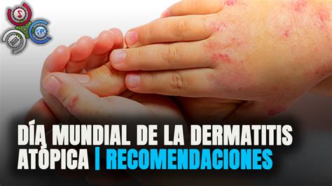 Día mundial de la Dermatitis Atópica Como saber si sufro de