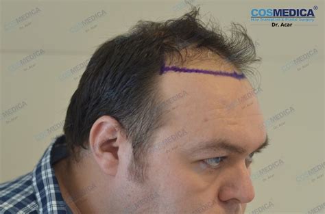 Haartransplantation In Der T Rkei Haar Transplantation Dr Acar