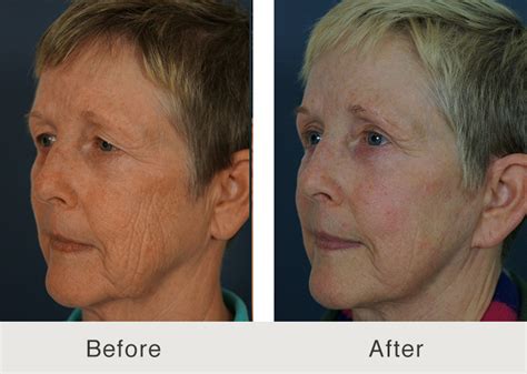 Medium Depth Chemical Peel With Combination Of Jessner S Solution And