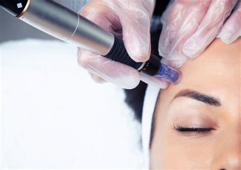 Does Microneedling Tighten The Skin Gold Coast Aesthetics