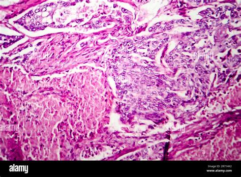 Lung Adenocarcinoma Light Micrograph Photo Under Microscope Stock