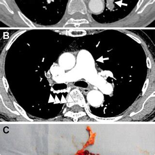 A Preoperative Computed Tomography Ct Scan Case Arrowheads Show