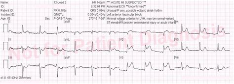 LAD Occlusion Often Presents Without Reciprocal Changes - ECG Medical ...