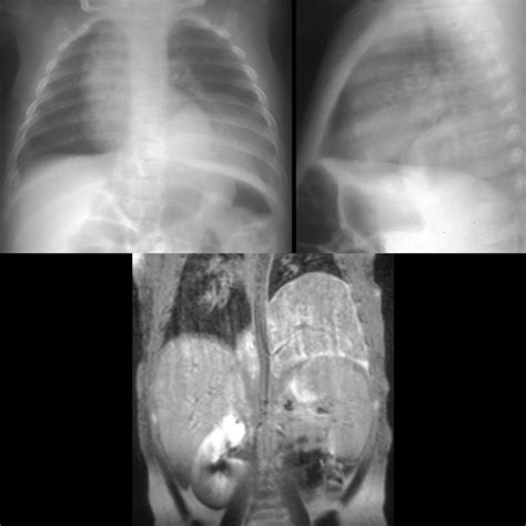 Pulmonary Sequestration | Pediatric Radiology Reference Article ...