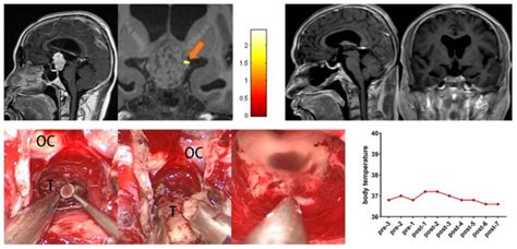 Preoperative Midsagittal Contrast Enhanced T1 Weighted Mri Scans Showed