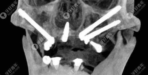 做穿颧穿翼种植手术的利弊上颌牙槽骨极度缺失者必看 知乎