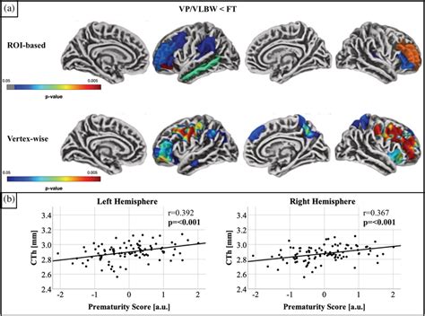 A Group Difference In Cortical Thickness The Upper Row Shows All