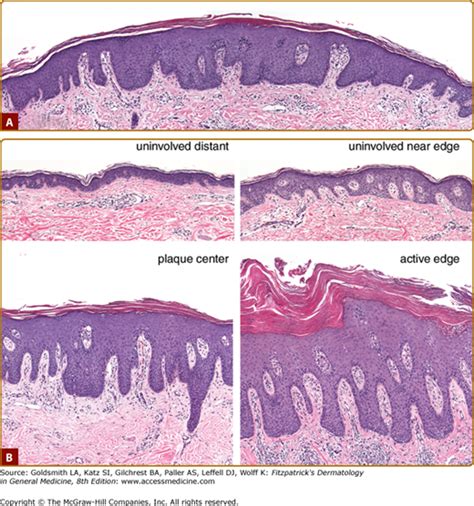 Psoriasis | Plastic Surgery Key