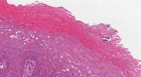 Hypertrophic candidiasis of the oral cavity | Ottawa Atlas of Pathology