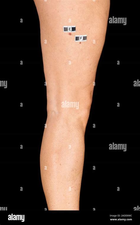 Dermatofibroma Diagnosis Examination Of Dermatofibromas On The Back Of