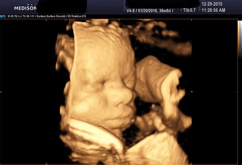 The Evolution Of Ultrasounds 2d 3d 4d 5d Compared 3d 4d Ultrasound