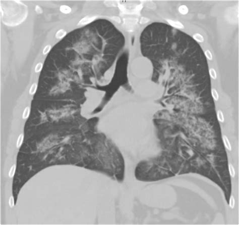 Idiopathic Pulmonary Hemosiderosis A State Of The Art Review Respiratory Medicine