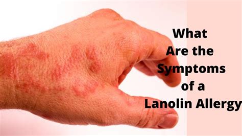 What Are The Symptoms Of A Lanolin Allergy Youtube