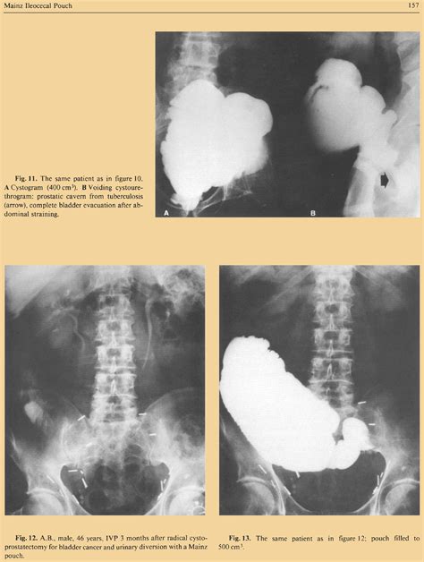 Urinary Diversion Highlights European Urology