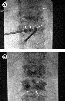 Kyphoplasty Techniques In Vascular Interventional Radiology