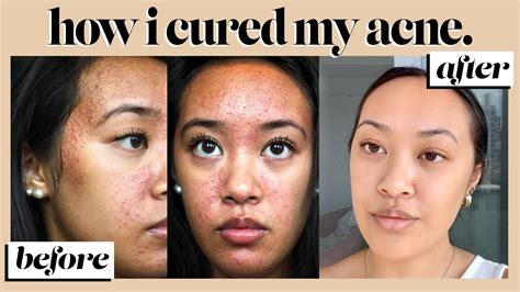 How I Cleared My Skin My Acne Journey And What To Do When It Comes Back