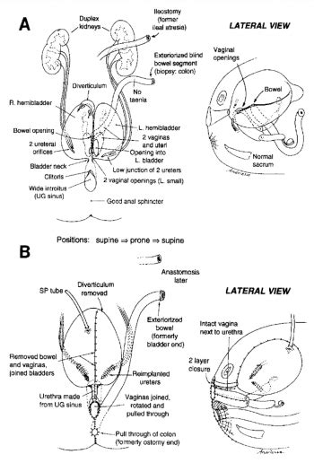 Cloacal Exstrophy Bottom W Hardy Hendren Pediatric Surgical And Urological Education Foundation