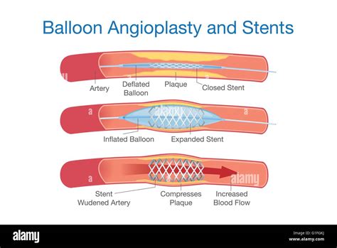 Tratamiento De Angioplastia Im Genes Vectoriales De Stock Alamy