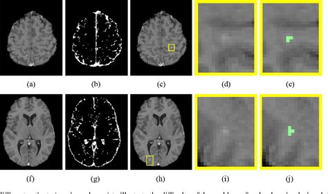 Figure 1 From Automatic Detection Of Gadolinium Enhancing Multiple Sclerosis Lesions In Brain