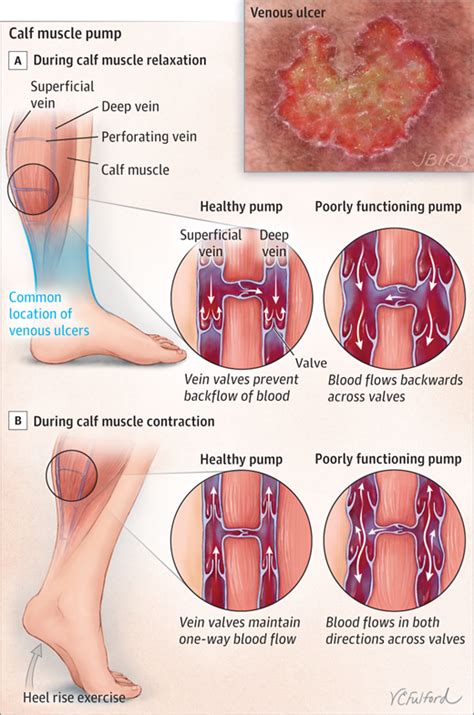 What Are Venous Ulcers