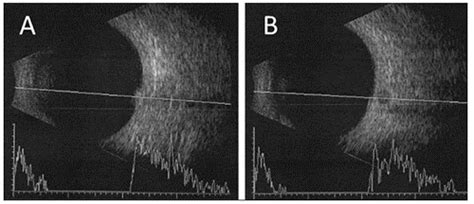 Optic Disk Melanocytoma And Optical Coherence Tomography Angiography Oct A Eyewiki