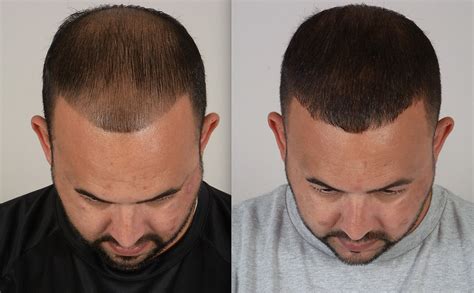 Hair Transplant Photos Katona Hair Transplants Florida