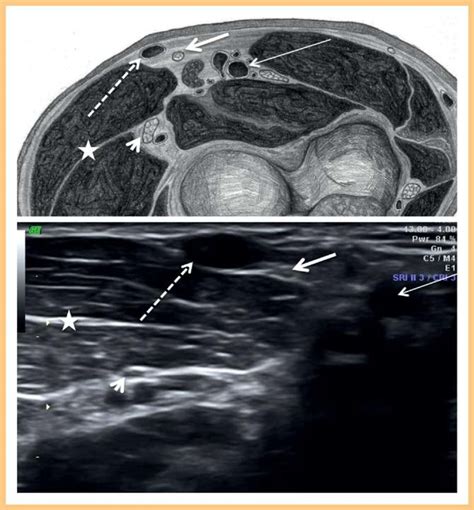 Position Of Lateral Antebrachial Cutaneous Nerve Labcn In Relation To Download Scientific