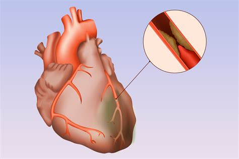 Stable Ischemic Heart Disease Ischemic Guideline Diseases Club Center