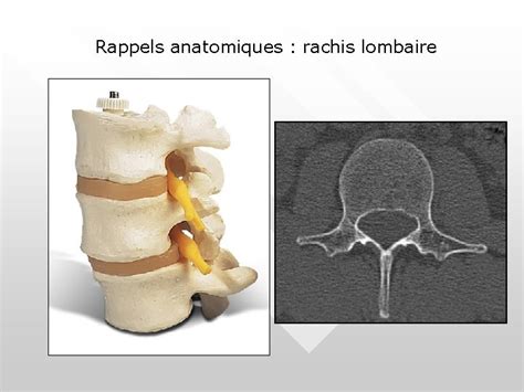 Exploration Radiologique Du Rachis Cervical Et Lombaire Dr