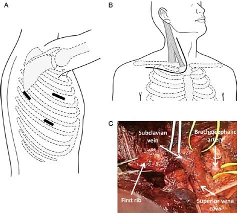 Schema Of The Surgical Approach And Intraoperative View Firstly The Download Scientific