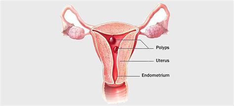 How Uterine Polyps Impact Fertility And Ivf Success Ivf Spring