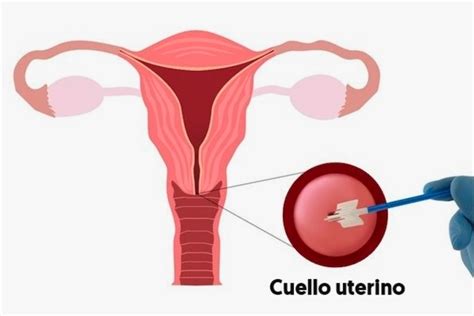 Requisitos de la prueba de Papanicolaou y cómo se hace Maestria Salud