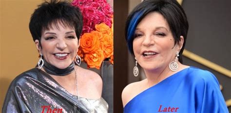 Liza Minnelli Plastic Surgery Before And After Photos