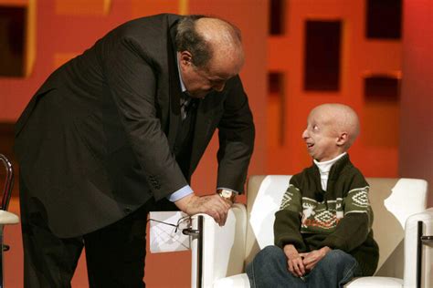 Che Cosa è La Progeria La Malattia Che Aveva Sammy Basso Sanità