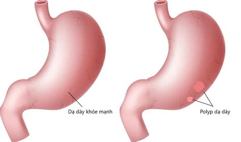 Some Types Of Stomach Polyps Vinmec