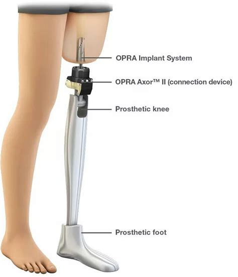 Artifical leg | Prosthetic leg, Orthotics and prosthetics, Leg prosthesis