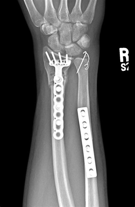 Distal Ulnar Fractures Concomitant With Distal Radius Fractures | Musculoskeletal Key