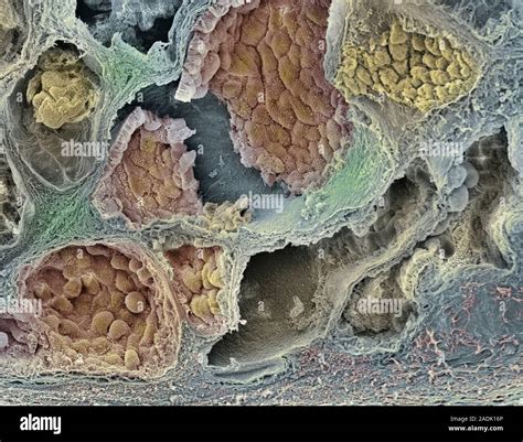 Prostate Cancer Coloured Freeze Fracture Scanning Electron Micrograph