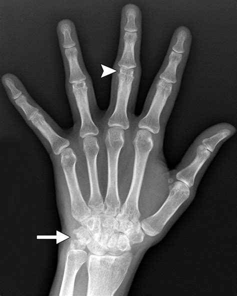 Imaging Of Juvenile Idiopathic Arthritis A Multimodality Approach Radiographics