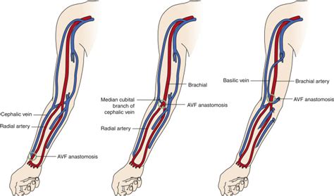 Dialysis Fistula