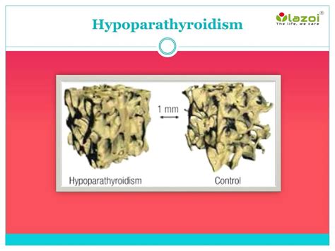 Ppt Hypoparathyroidism Symptoms Causes Treatment And More Powerpoint Presentation Id 7739858