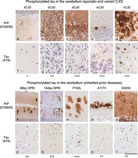 Prion Protein Triggered Tau Phosphorylation In The Cerebellum Upper