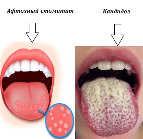 Как убрать жжение во рту причины и лечение Cis